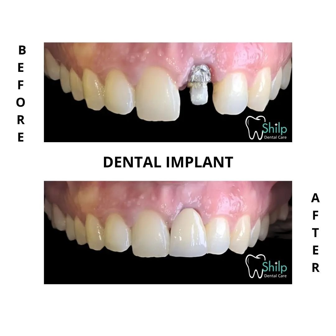 Dental Implant Cost